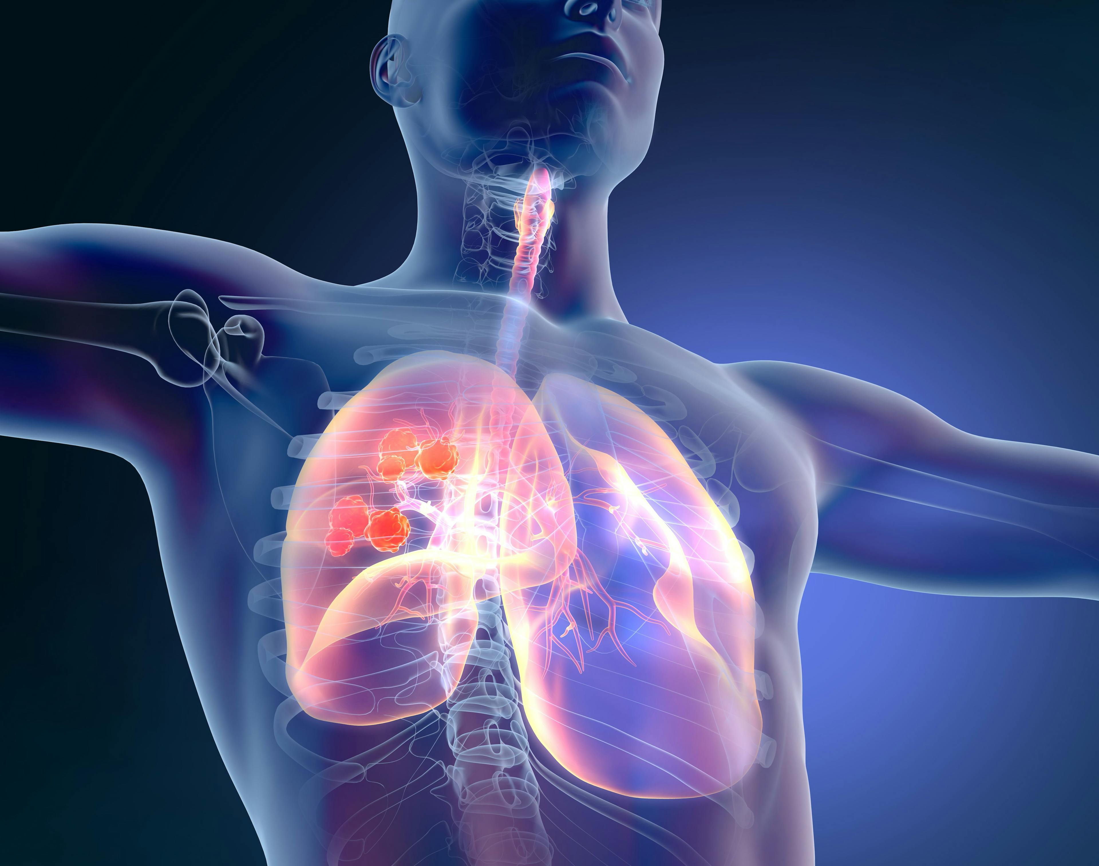 FDA Grants Priority Review to Atezolizumab for the Treatment of Non–Small Cell Lung Cancer