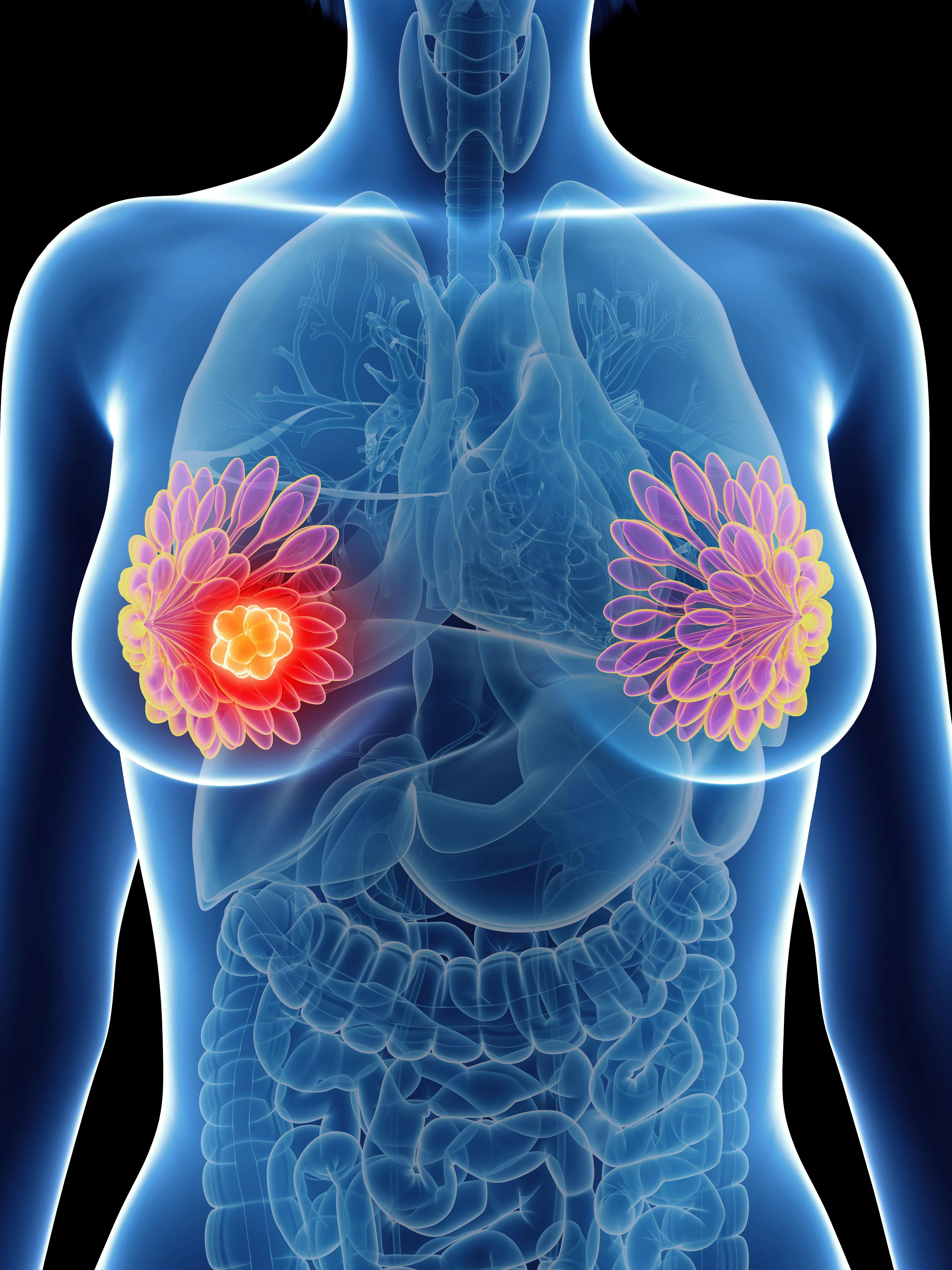 Event-Free Survival Improvement Noted in KEYNOTE-522 Study for Patients With Triple-Negative Breast Cancer
