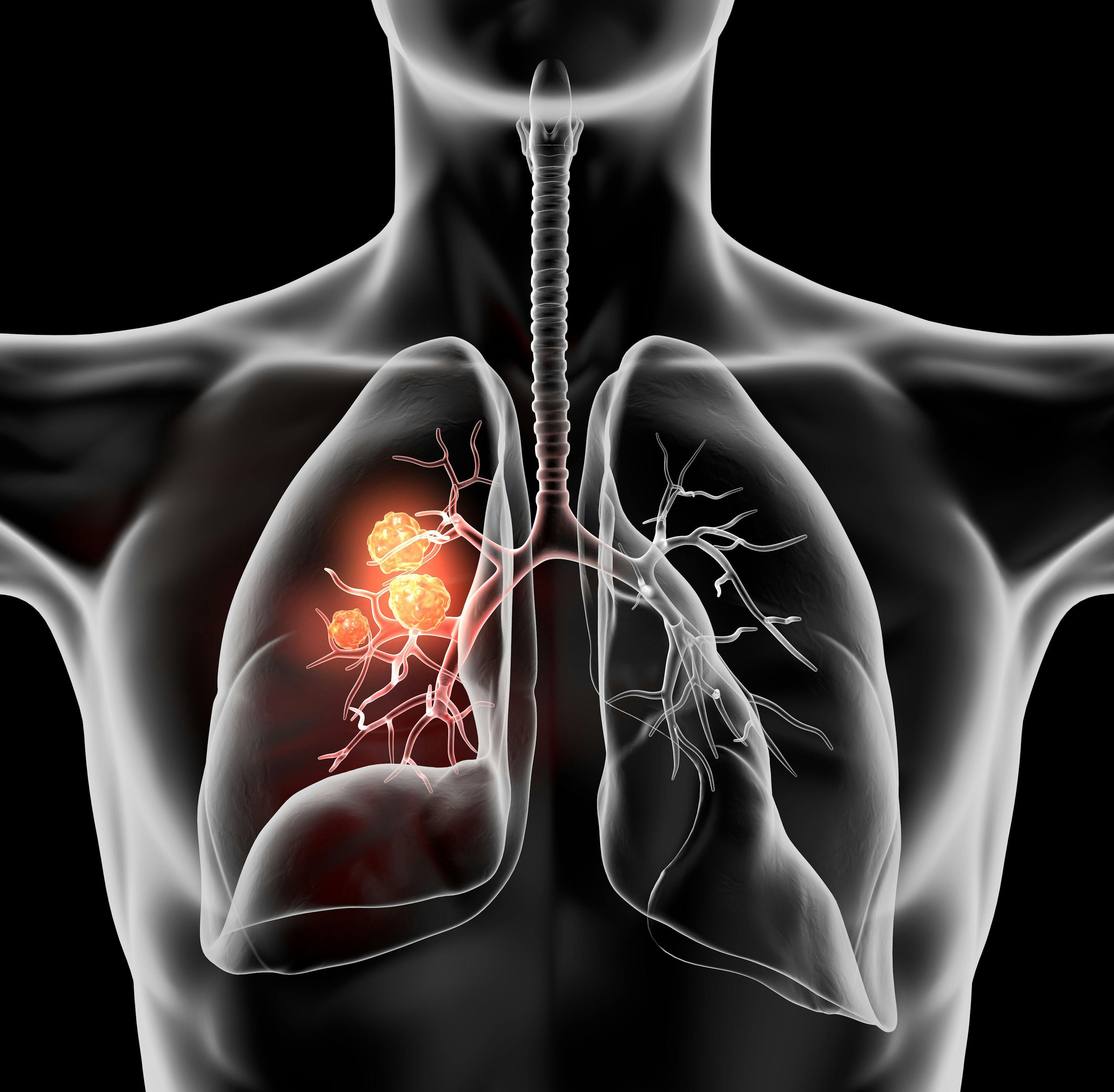 Neoadjuvant nivolumab combination followed by surgery and adjuvant nivolumab show an improvement in event-free survival for patients with previously untreated resectable stage II to IIIB non-small cell lung cancer.