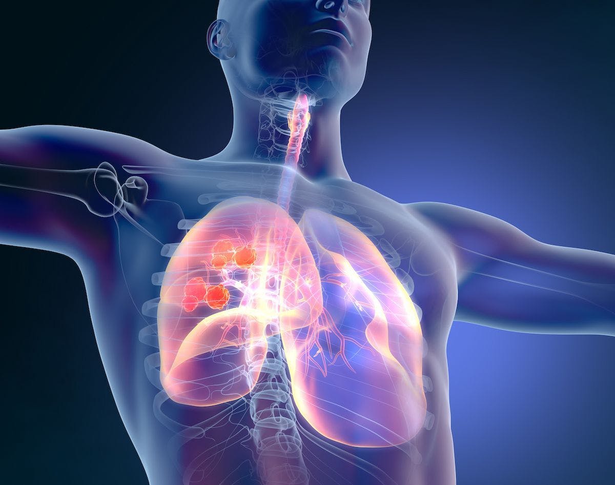 In March 2024, the FDA approved amivantamab plus chemotherapy for patients with locally advanced or metastatic NSCLC harboring EGFR exon 20 insertion mutations as detected with an FDA-approved test.