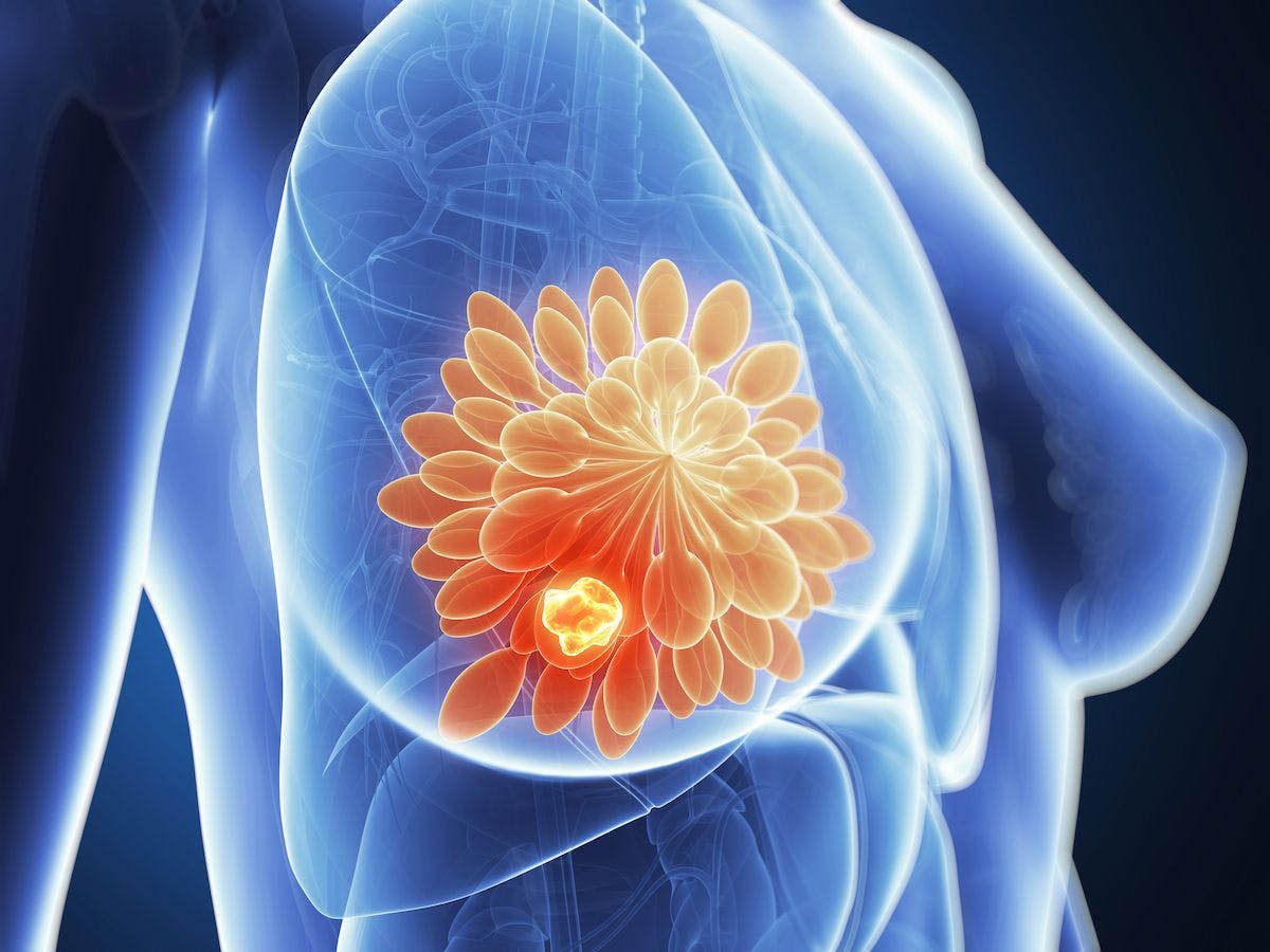 "Taken together, our findings support the use of fuzuloparib plus apatinib or fuzuloparib alone in [patients with] HER2-negative metastatic breast cancer with a germline BRCA mutation," according to study author Huiping Li.