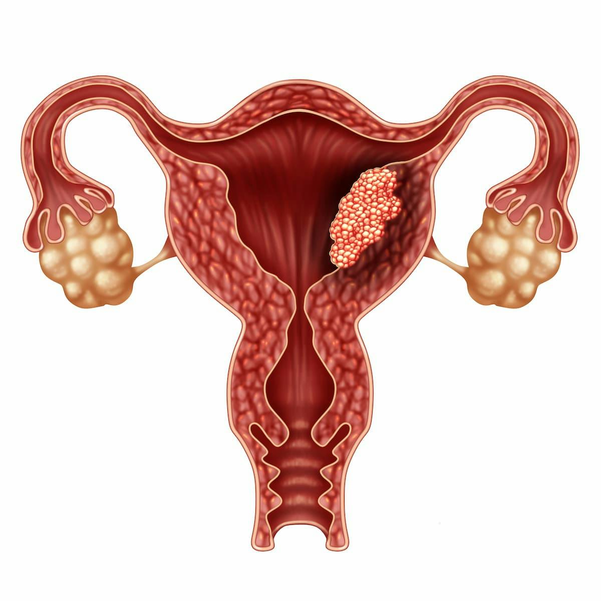 Pembrolizumab Combo Yields Survival Benefit in Endometrial Cancer