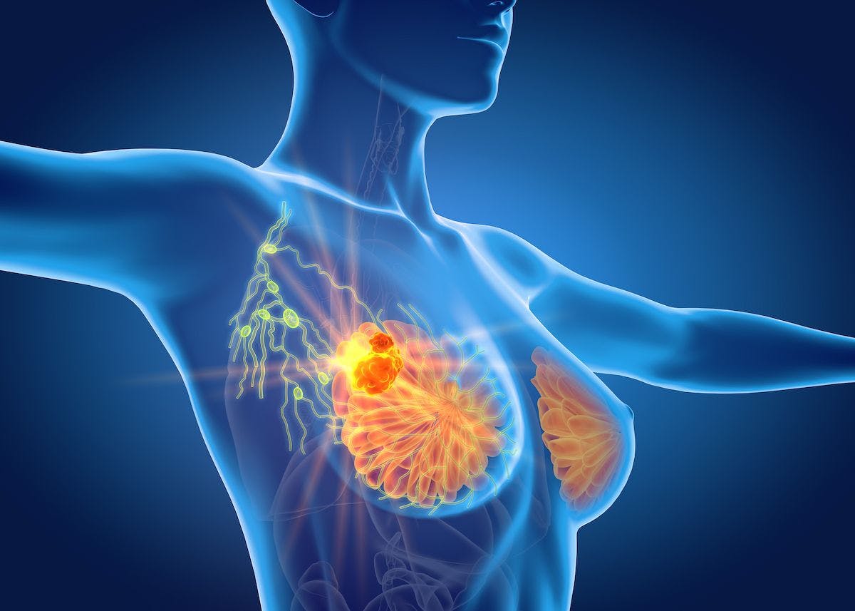 Quality of life also appears to be maintained with elacestrant in estrogen receptor–positive or HER2-negative ESR1-mutated breast cancer in the phase 3 EMERALD trial.