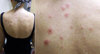 A 60-Year-Old Woman Treated for RCC Develops a Nonpruritic, Slightly Tender Cutaneous Eruption