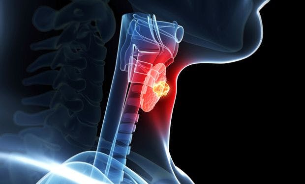 An observed extension in progression-free survival with nintedanib vs placebo did not warrant continued development of the therapy for thyroid cancer.