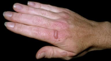 A 61-Year-Old Caucasian Woman Presents With History of “Bizarre Insect Bites”