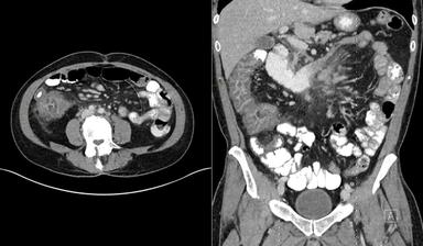 Neutropenia and Abdominal Pain in a 30-Year-Old Patient