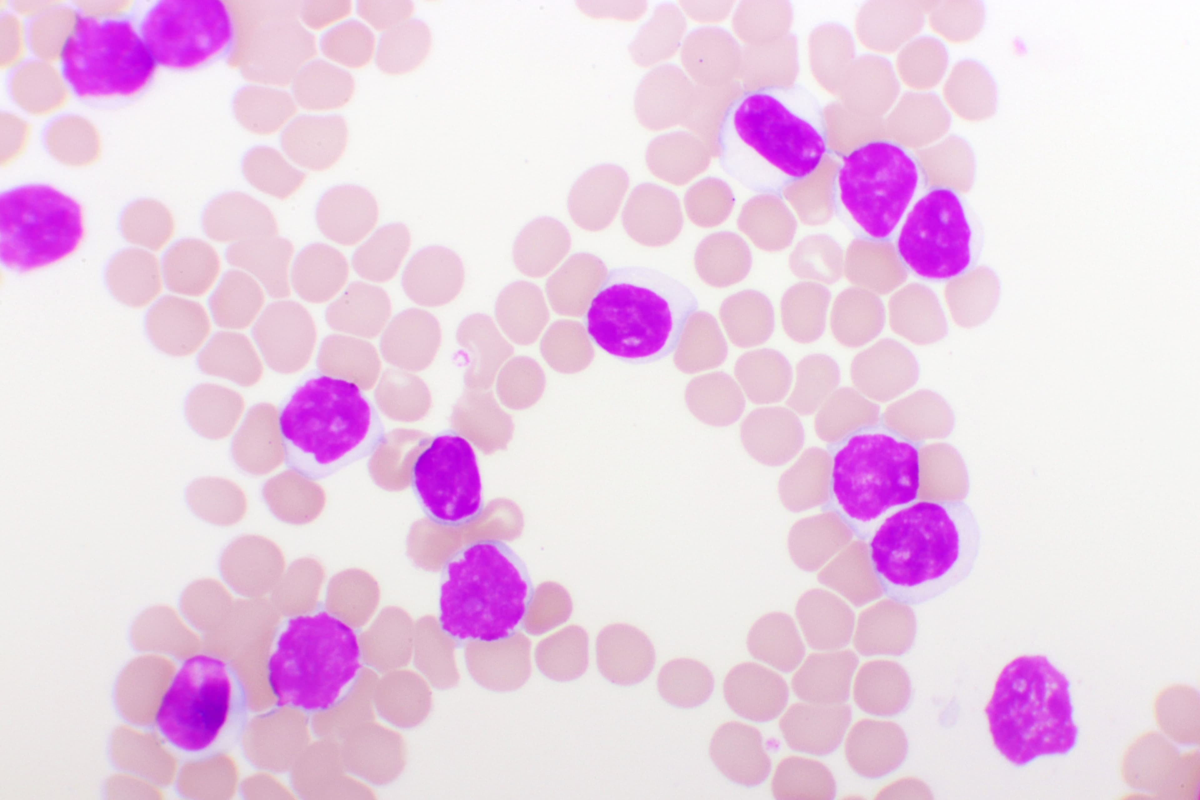 chronic lymphocytic leukemia