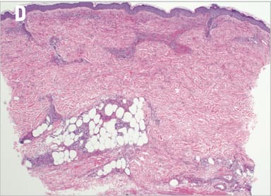 Leukocytoclastic Vasculitis Induced by Immune Checkpoint Inhibition in a Patient With Advanced Renal Cell Carcinoma