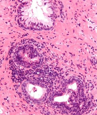 Inflammation in Prostate Biopsy May Predict Lower Cancer Risk