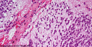 Nasal Tumor Found in 46-Year-Old Man