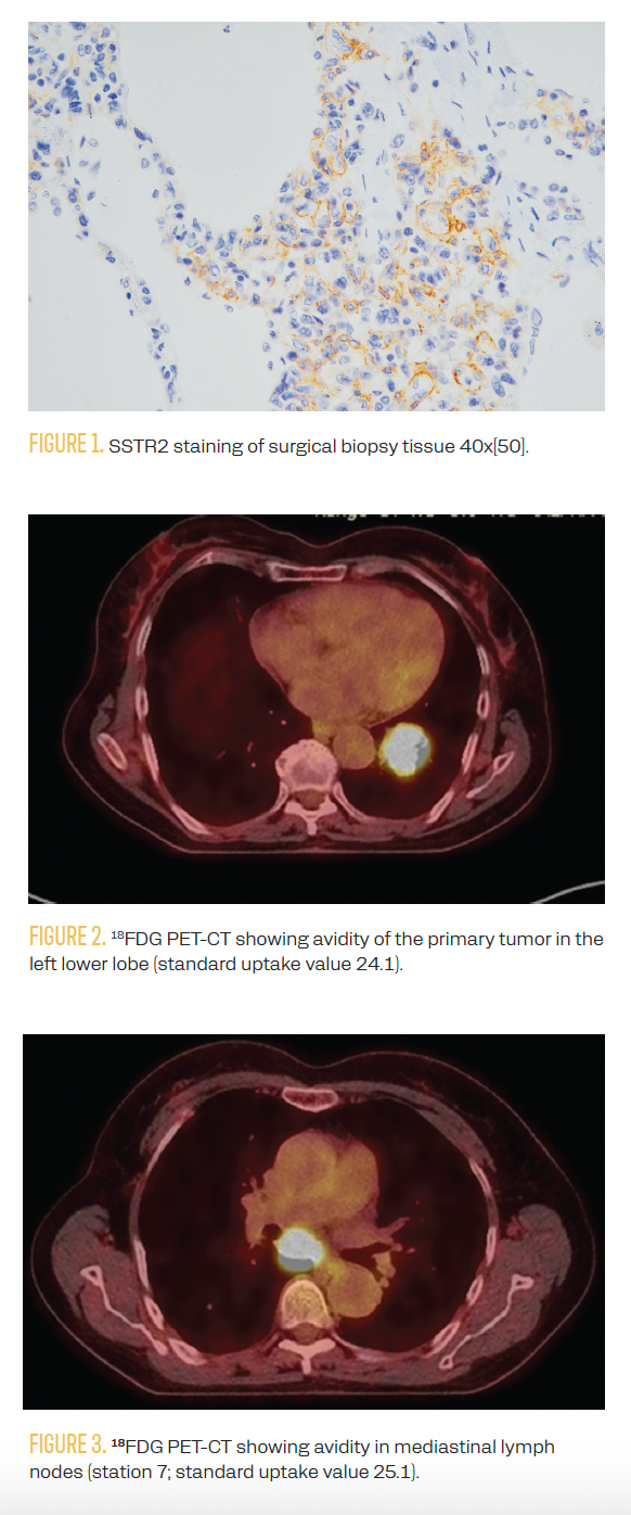 FIGURE 1. SSTR2 staining of surgical biopsy tissue 40x[50].

FIGURE 2. 18FDG PET-CT showing avidity of the primary tumor in the left lower lobe (standard uptake value 24.1).

FIGURE 3. 18FDG PET-CT showing avidity in mediastinal lymph nodes (station 7; standard uptake value 25.1).