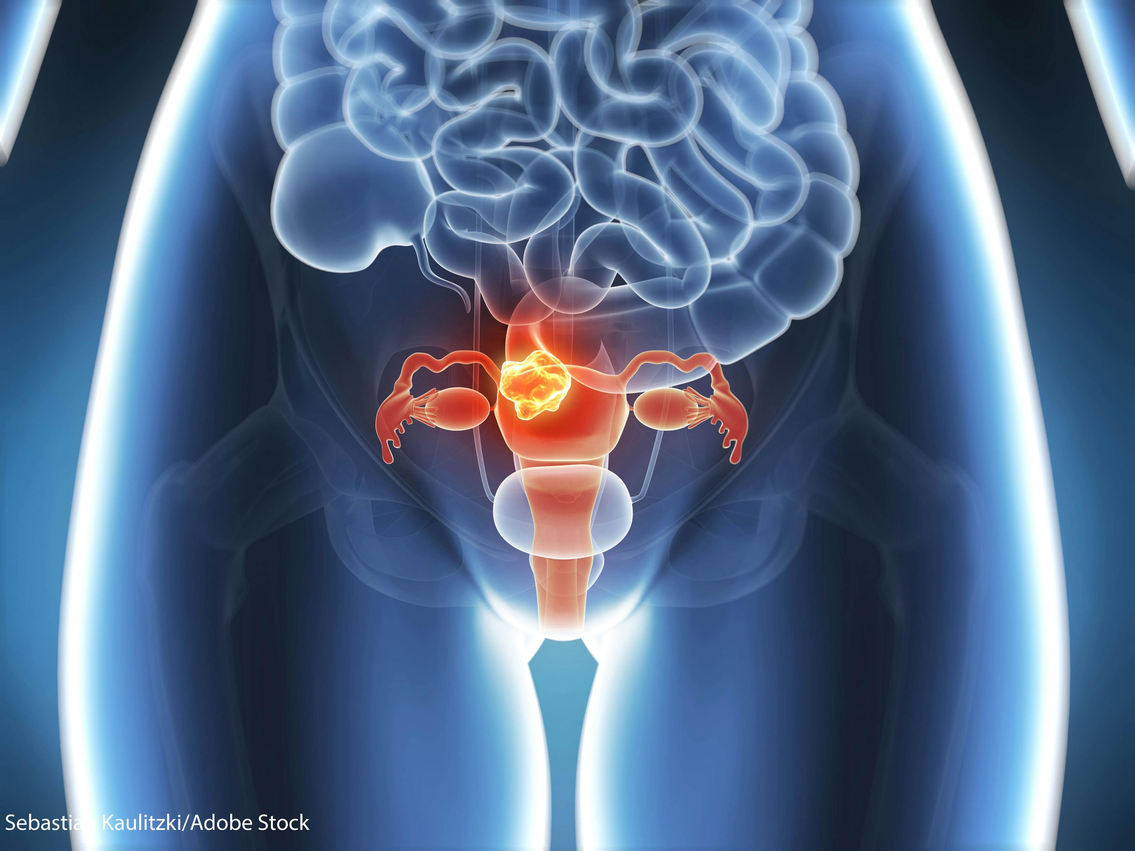 PAX8, a marker for aggressive disease in numerous cancer types, was more highly expressed in Black patients with uterine serous carcinoma.