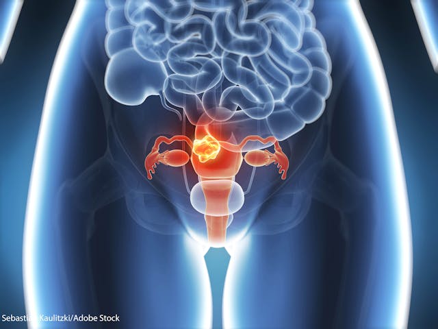 PAX8, a marker for aggressive disease in numerous cancer types, was more highly expressed in Black patients with uterine serous carcinoma.