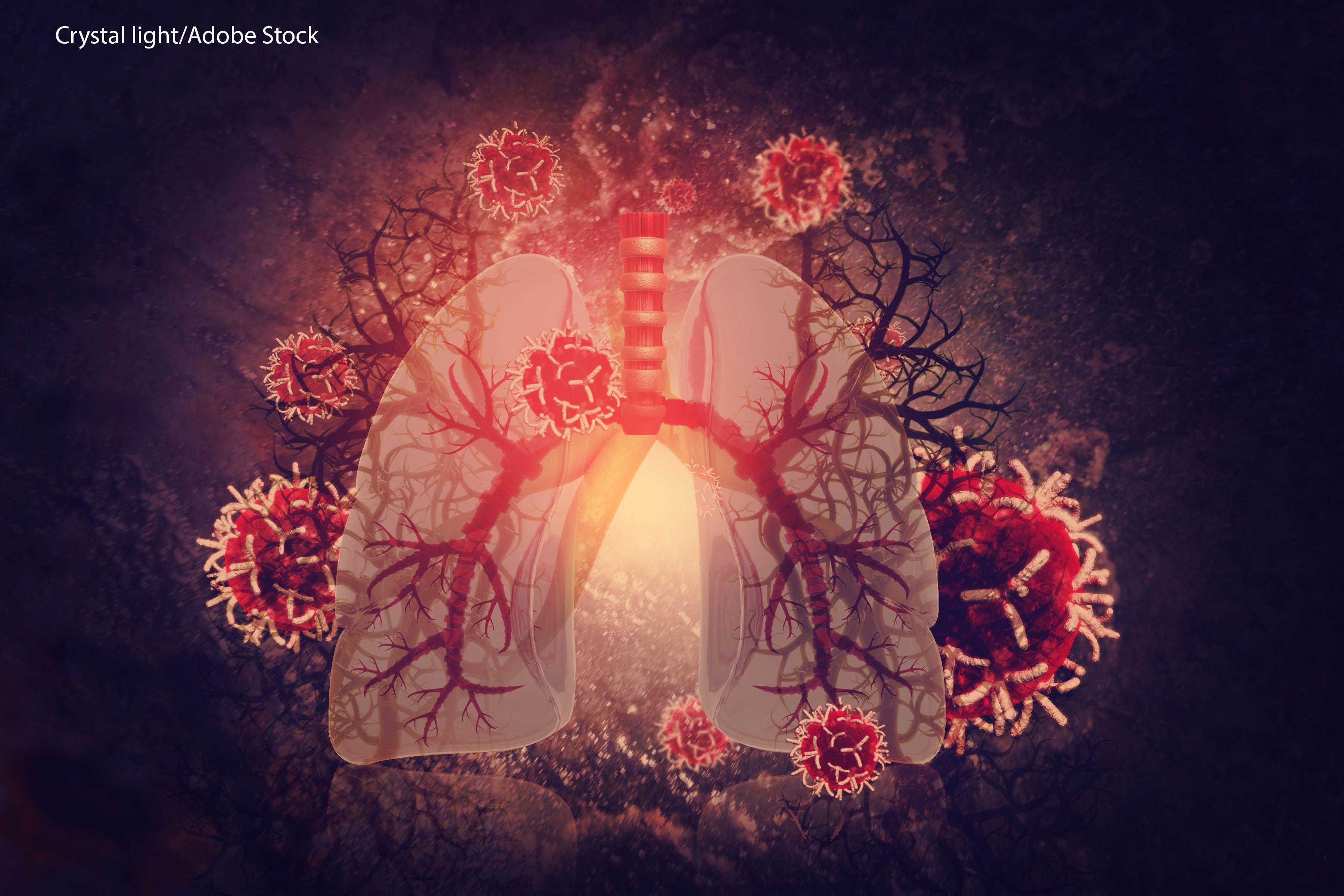 Telisotuzumab Vedotin Shows Durable Responses in EGFR Wild-type, c-MET+ NSCLC | Image Credit: © Crystal light - stock.adobe.com.