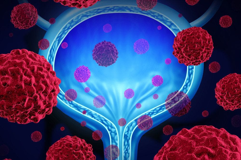 Adjuvant sacituzumab govitecan demonstrated a complete response, but its future in bladder cancer is uncertain after a recent protocol amendment.