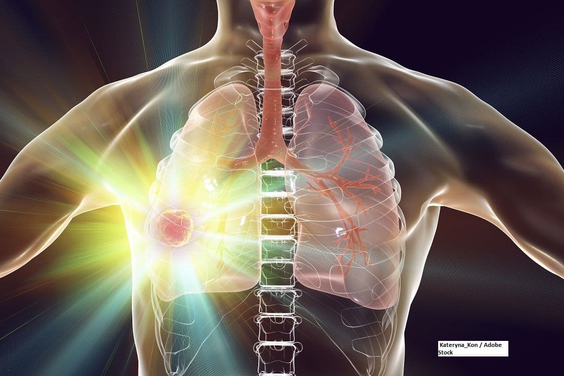 Results showed of the phase 3 ADRIATIC study found that treatment with durvalumab elicited similar radiation pneumonitis incidences vs placebo for LS-SCLC.