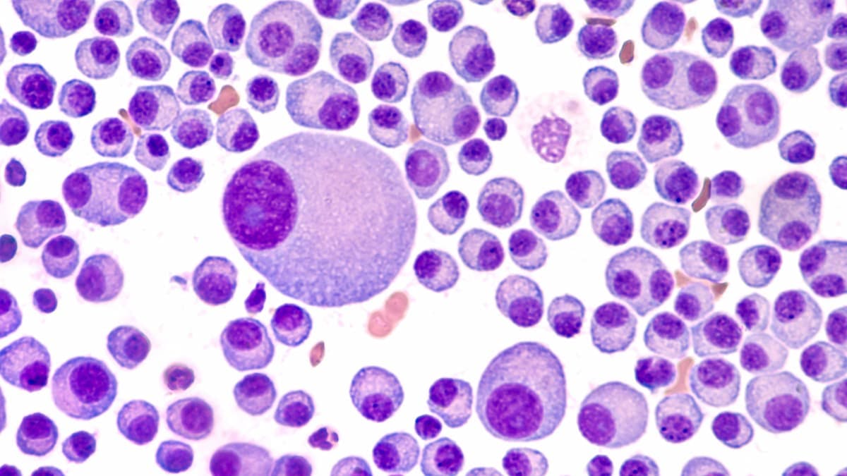 Data suggest that those with relapsed/refractory multiple myeloma and poor functional status may benefit from talquetamab without increased toxicity.