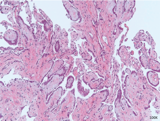 FIGURE 4: Papillary mesothelial proliferation. Papillary fronds lined by bland cuboidal mesothelial cells consistent with well-differentiated papillary mesothelioma. This is considered a tumor of uncertain malignant potential (×100 magnification)