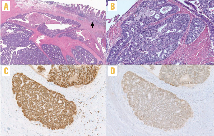 FIGURE 2: Histopathology of right colectomy specimen. (A) The tumor invades the small bowel wall underlying the small intestinal mucosa (arrow). The tumor cells are arranged as back-to-back glands with little to no intervening stroma. There is associated necrosis within some of the tumor nests (×20 magnification) (B) The invasive tumor has a cribriform architecture composed of glands lined by columnar cells with round to elongated, pseudostratified nuclei and mild nuclear enlargement (×100 magnification) (C) Estrogen receptor is positive in the tumor glands, suggesting endometrioid adenocarcinoma (×100 magnification) (D) PAX8 is positive in the tumor glands, which is a marker of Müllerian origin and is positive in endometrioid adenocarcinoma (×100 magnification)