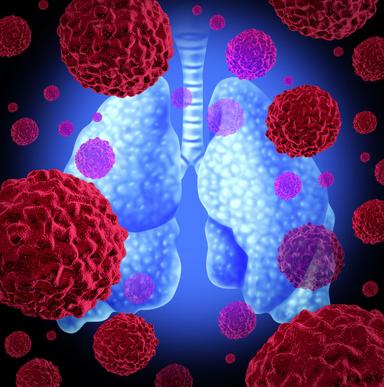 Regardless of T790M status, lazertinib hindered the progression of intracranial metastases after unsuccessful EGFR TKI treatment in patients with EGFR-mutated NSCLC.