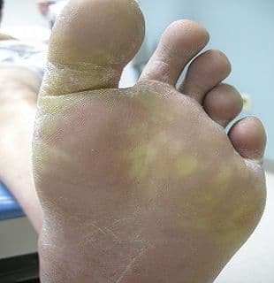 A 60-Year-Old Man Presents With Plantar Hyperkeratosis & Erythema 