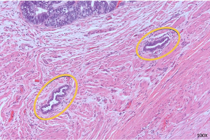 FIGURE 3: Endometriosis focally seen within the ileum and colon. There are focal isolated endometrial glands with pseudostratified nuclei and little to no endometrial stroma. These are dispersed as single glands and do not have the complex architecture of endometrioid adenocarcinoma, such as back-to-back glands with no intervening stroma or a cribriform architecture as is seen at the top of this image. In long-standing endometriosis, the endometrial stroma can become lost or attenuated as seen here. If there is no evidence of endometrioid adenocarcinoma within the uterus or adnexa of this patient, then it can be assumed that this adenocarcinoma arose from the endometriosis involving the bowel wall (100X magnification)