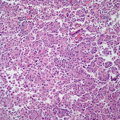 Pleural Effusion in a 58-Year-Old Male With Chest Pain