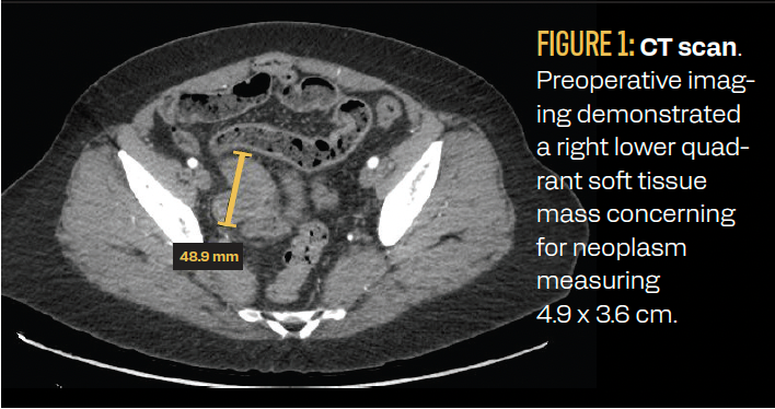 FIGURE 1: CT scan. Preoperative imaging demonstrated a right lower quadrant soft tissue mass concerning for neoplasm measuring 4.9 x 3.6 cm.