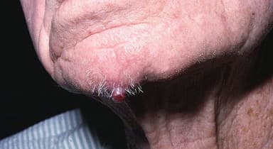 A 71-Year-Old Male Presents for Evaluation of Painless Bump on His Chin