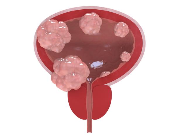 The decision is backed by robust efficacy data from the phase 3 ENVISION trial, evaluating UGN-102 in patients with non-muscle invasive bladder cancer.