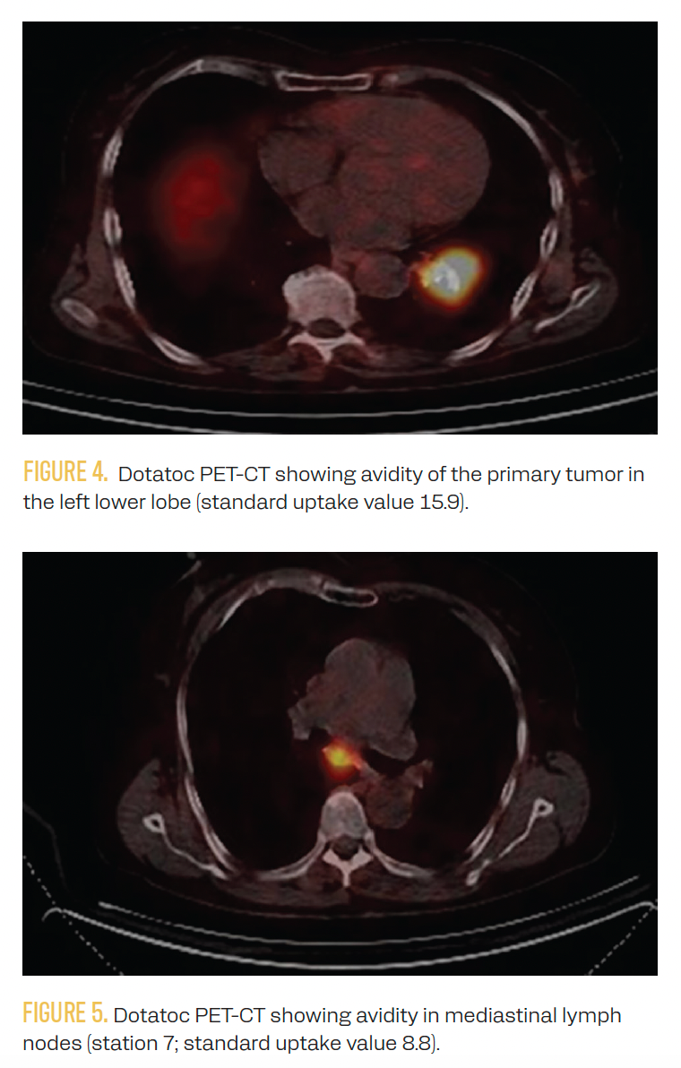 FIGURE 4. Dotatoc PET-CT showing avidity of the primary tumor in the left lower lobe (standard uptake value 15.9).

FIGURE 5. Dotatoc PET-CT showing avidity in mediastinal lymph nodes (station 7; standard uptake value 8.8).