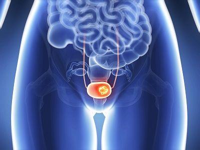 UGN-102 also demonstrated a 79.6% complete response rate at 3 months in the phase 3 ENVISION trial.