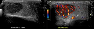 Palpable Nodule in Testicle of Young Man