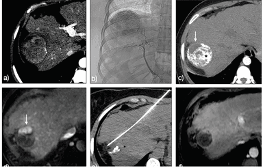 How to Radiologically Assess and Follow Response After Treatment of Hepatocellular Carcinoma 