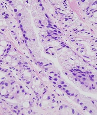 Protein in Prostate Biopsy May Signal Higher Risk of Cancer