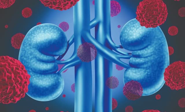 Phase 3 data support benmelstobart/anlotinib as a new potential standard in the frontline treatment of patients with advanced renal cell carcinoma.