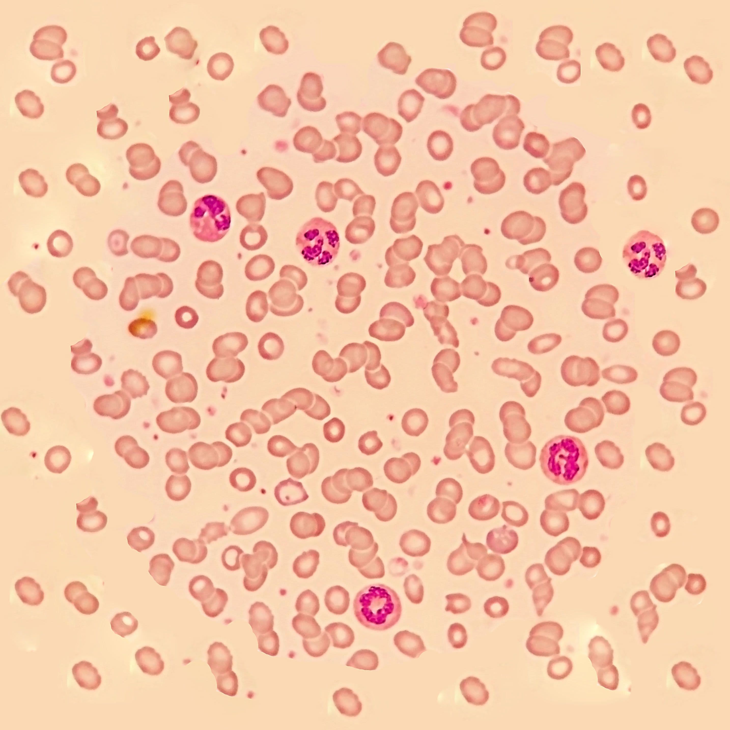 Acute lymphoblastic leukemia