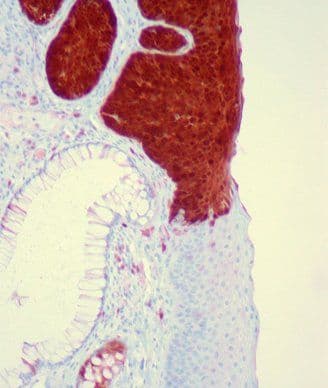 HPV, p16 Associated With Outcomes in Anal Canal Carcinoma