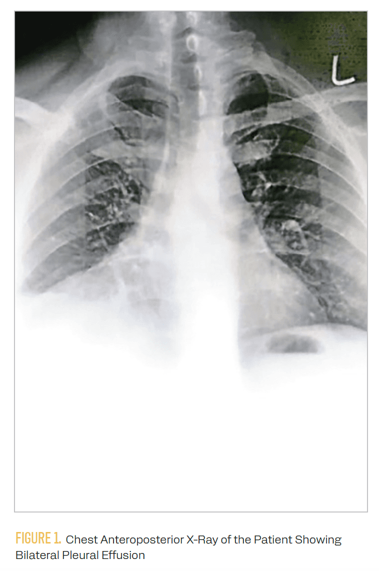 FIGURE 1. Chest Anteroposterior X-Ray of the Patient Showing Bilateral Pleural Effusion