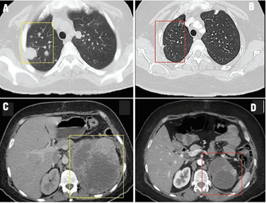 Metastatic Renal Cell Carcinoma With Sarcomatoid Features