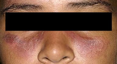 Photosensitive Facial Rash Depicted Along with Polyarticular Arthralgias