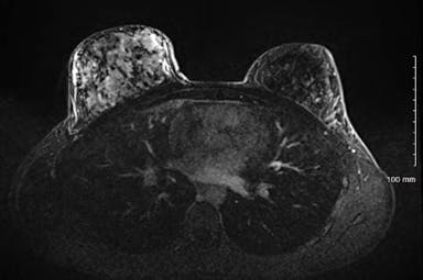 A 22-Year-Old Woman With Pain, Tenderness and Swelling in the Breast