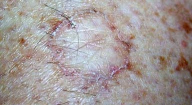 A 34-Year-Old Man Presents With an Expanding Lesion on the Right Arm