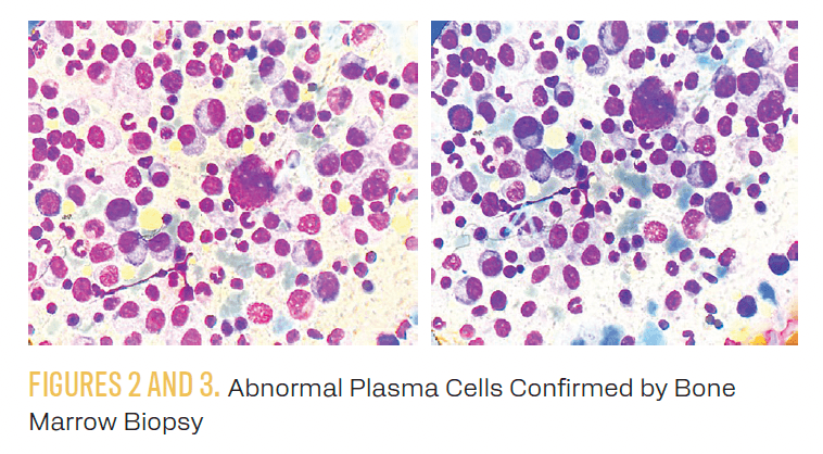 FIGURES 2 AND 3. Abnormal Plasma Cells Confirmed by Bone Marrow Biopsy