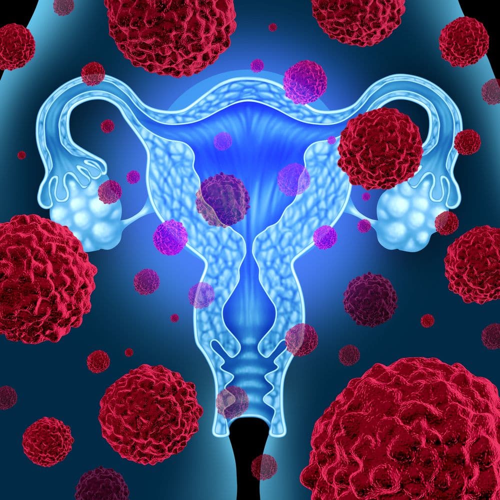 Developers initiated the rolling NDA submission for avutometinib/defactinib as a therapy for those with KRAS-mutated recurrent LGSOC in May 2024.