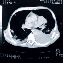 Two Regimens Yield Similar Survival in Advanced NSCLC